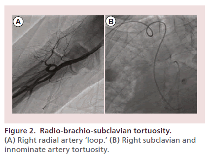 interventional-cardiology-Radio-brachio-subclavian
