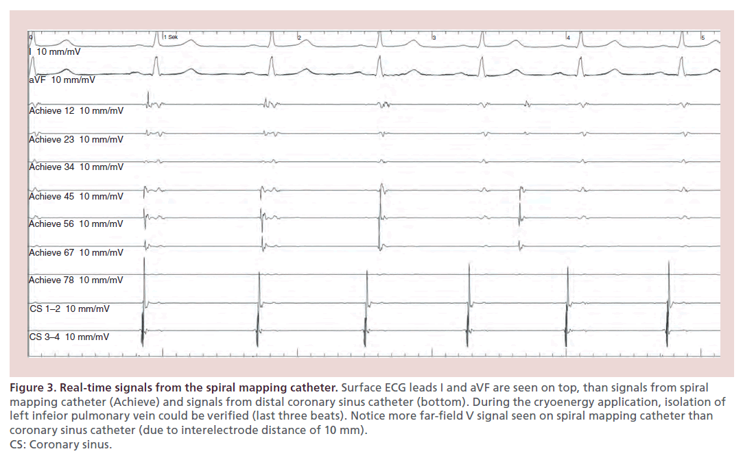 interventional-cardiology-Real-time-signals