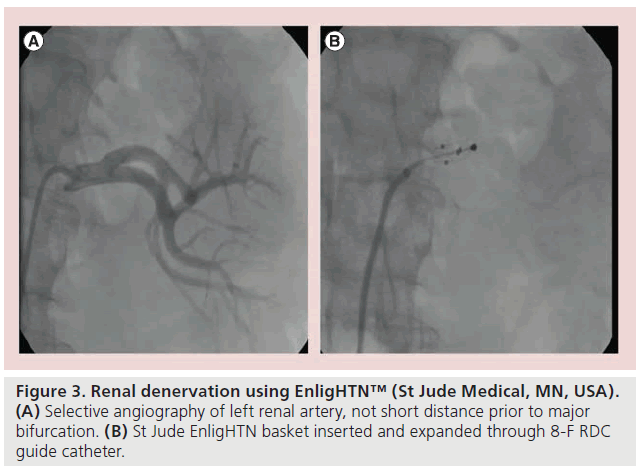 interventional-cardiology-Renal-denervation