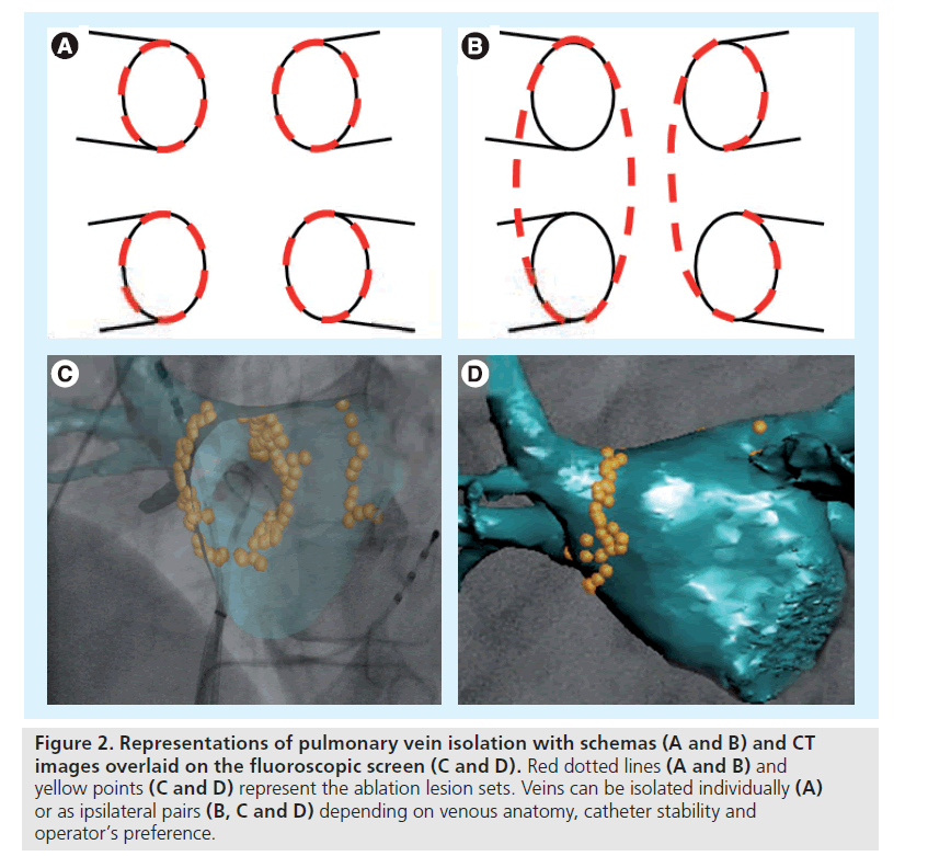 interventional-cardiology-Representations-pulmonary