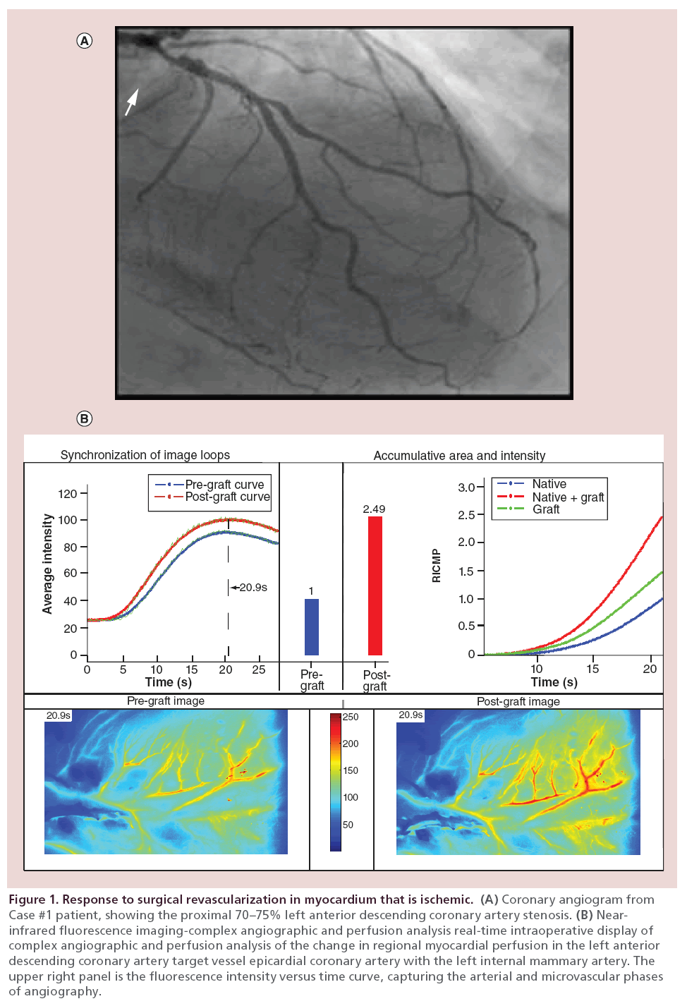 interventional-cardiology-Response-surgical-revascularization