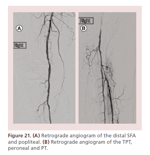 interventional-cardiology-Retrograde-angiogram