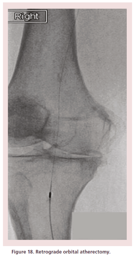 interventional-cardiology-Retrograde-orbital-atherectomy