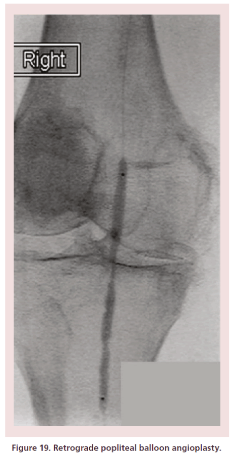 interventional-cardiology-Retrograde-popliteal