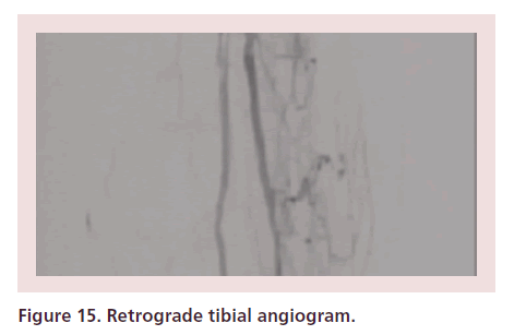 interventional-cardiology-Retrograde-tibial-angiogram