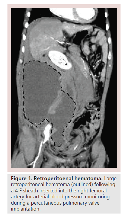 interventional-cardiology-Retroperitoenal-hematoma