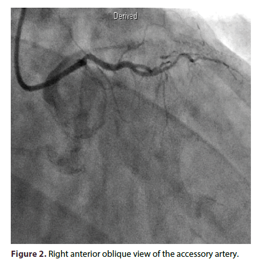 interventional-cardiology-Right-anterior