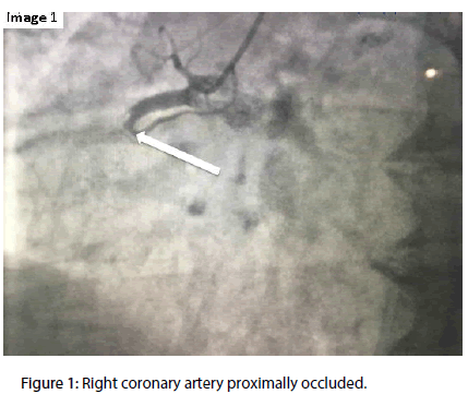 interventional-cardiology-Right-coronary