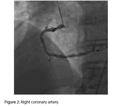 interventional-cardiology-Right-coronary