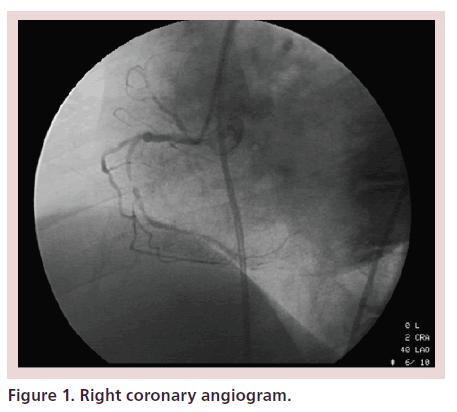 interventional-cardiology-Right-coronary-angiogram