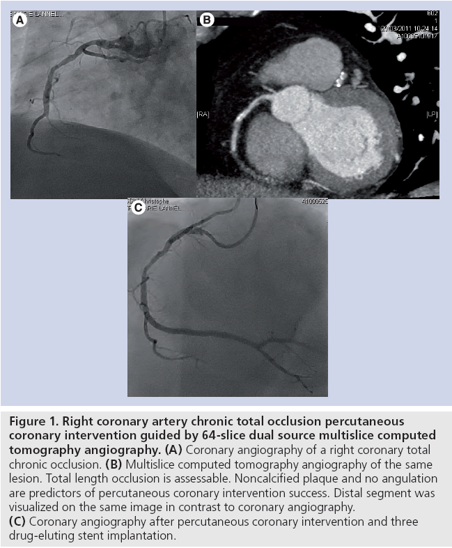 interventional-cardiology-Right-coronary-artery