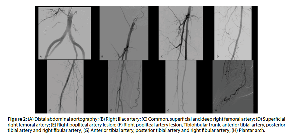 interventional-cardiology-Right-iliac