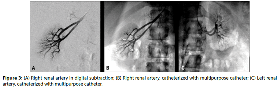interventional-cardiology-Right-renal