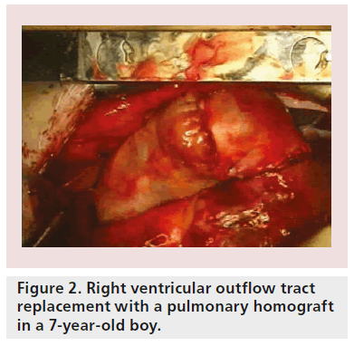 interventional-cardiology-Right-ventricular-outflow