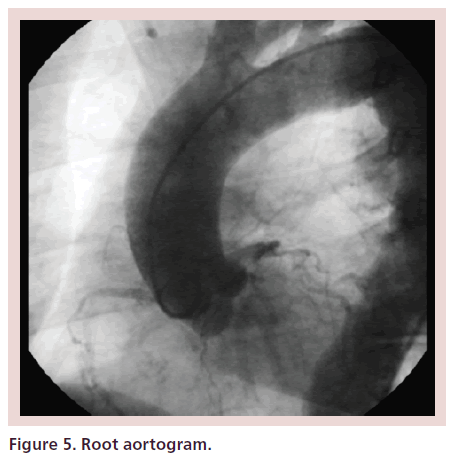 interventional-cardiology-Root-aortogram