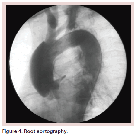 interventional-cardiology-Root-aortography
