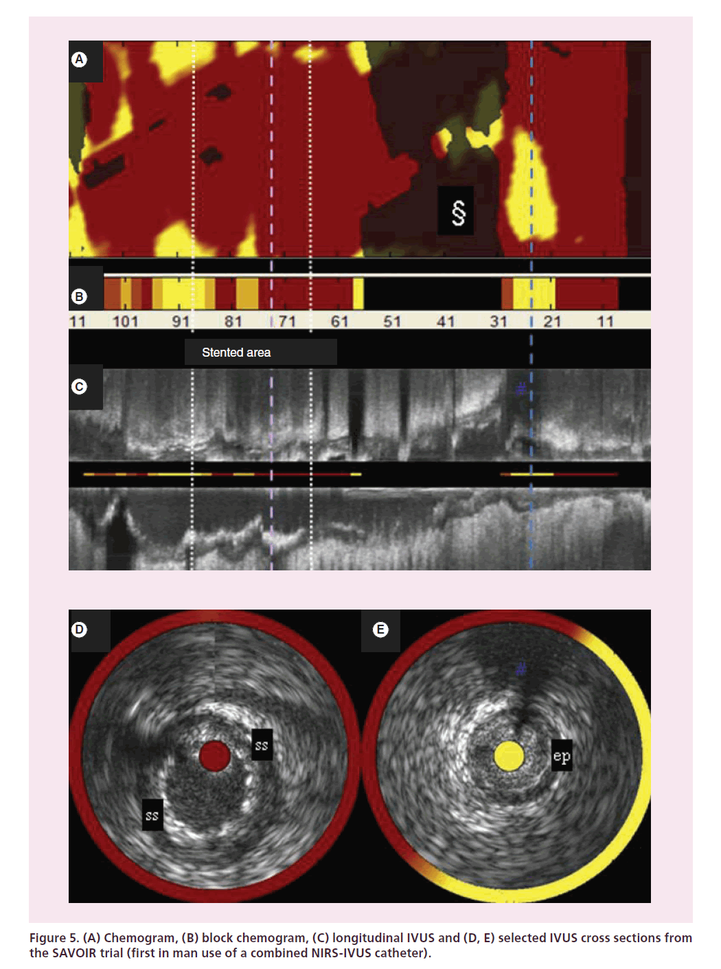 interventional-cardiology-SAVOIR-trial