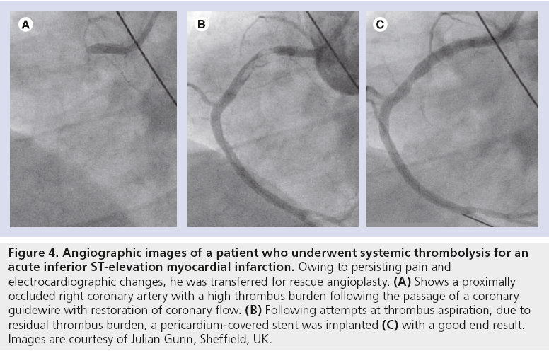 interventional-cardiology-ST-elevation-myocardial