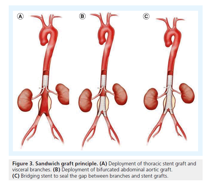 interventional-cardiology-Sandwich-graft