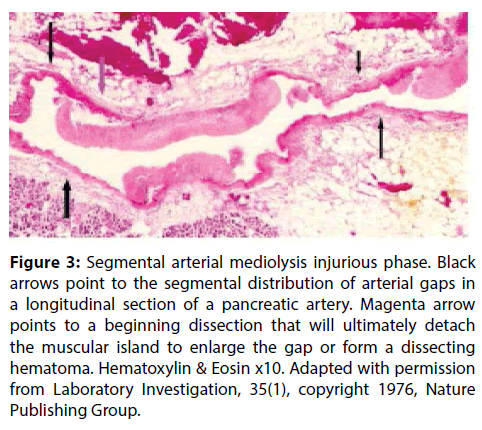 interventional-cardiology-Segmental-arterial