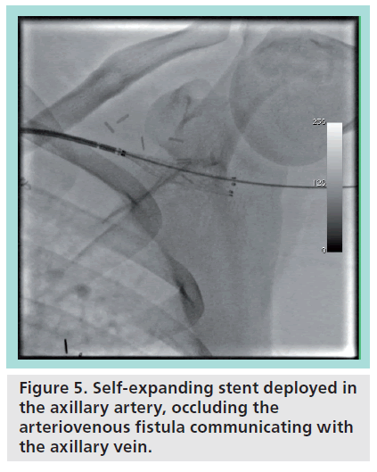 interventional-cardiology-Self-expanding-stent