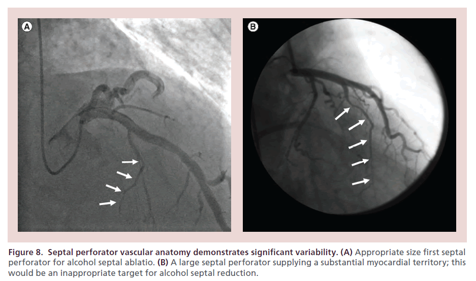 interventional-cardiology-Septal-perforator