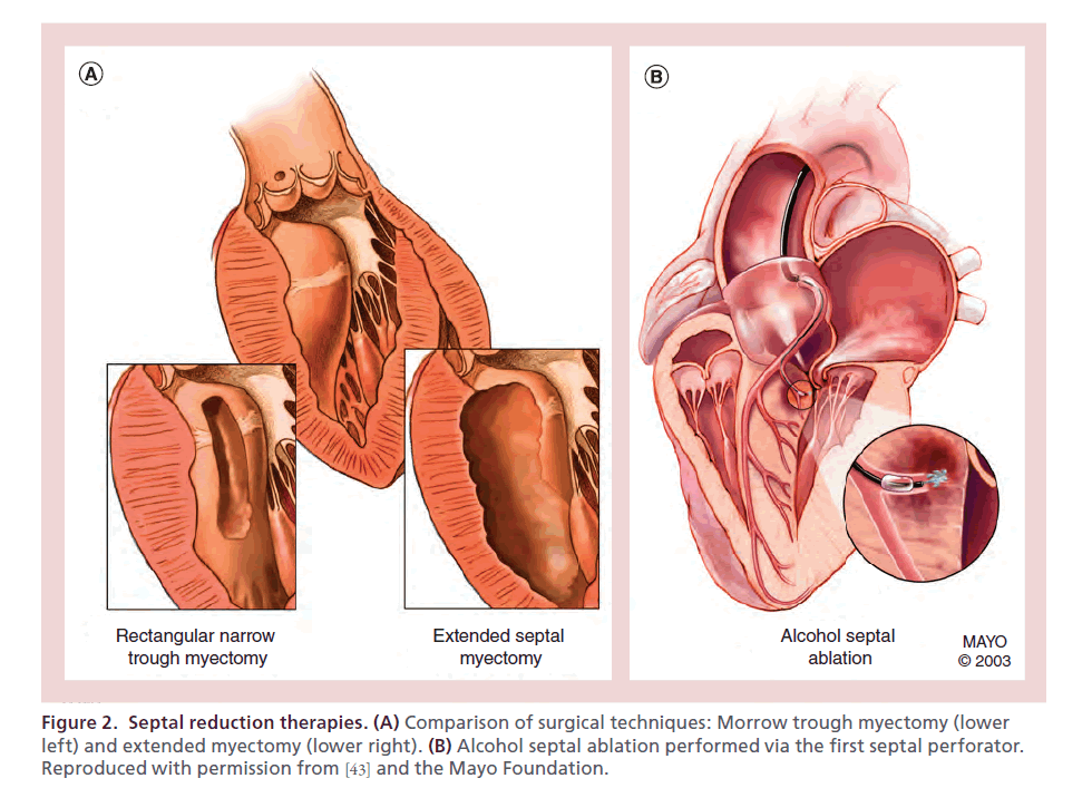 interventional-cardiology-Septal-reduction