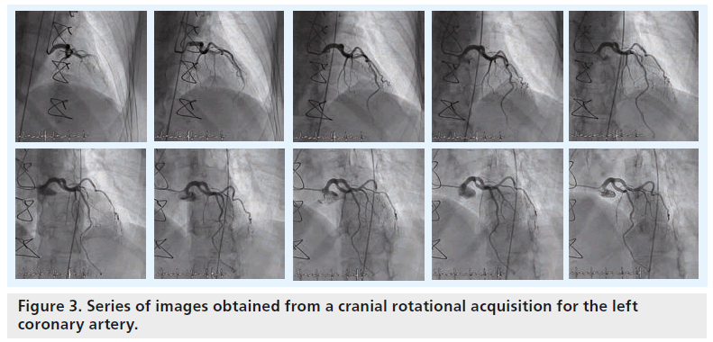 interventional-cardiology-Series-rotational