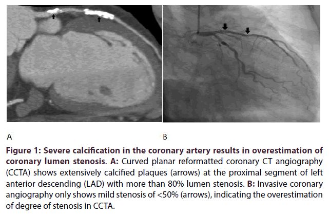 interventional-cardiology-Severe-calcification