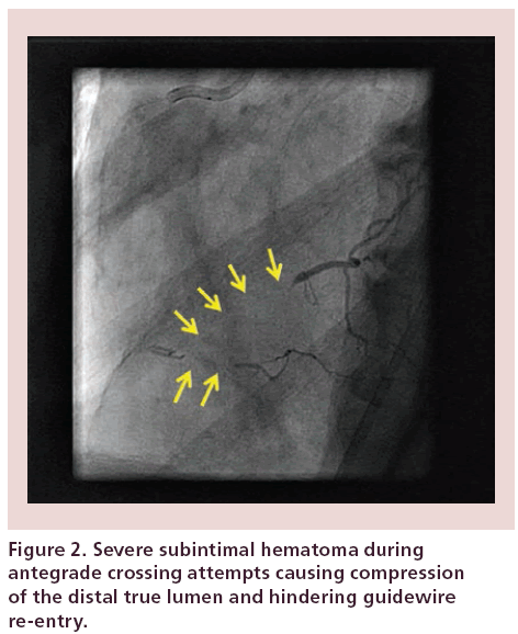interventional-cardiology-Severe-subintimal-hematoma