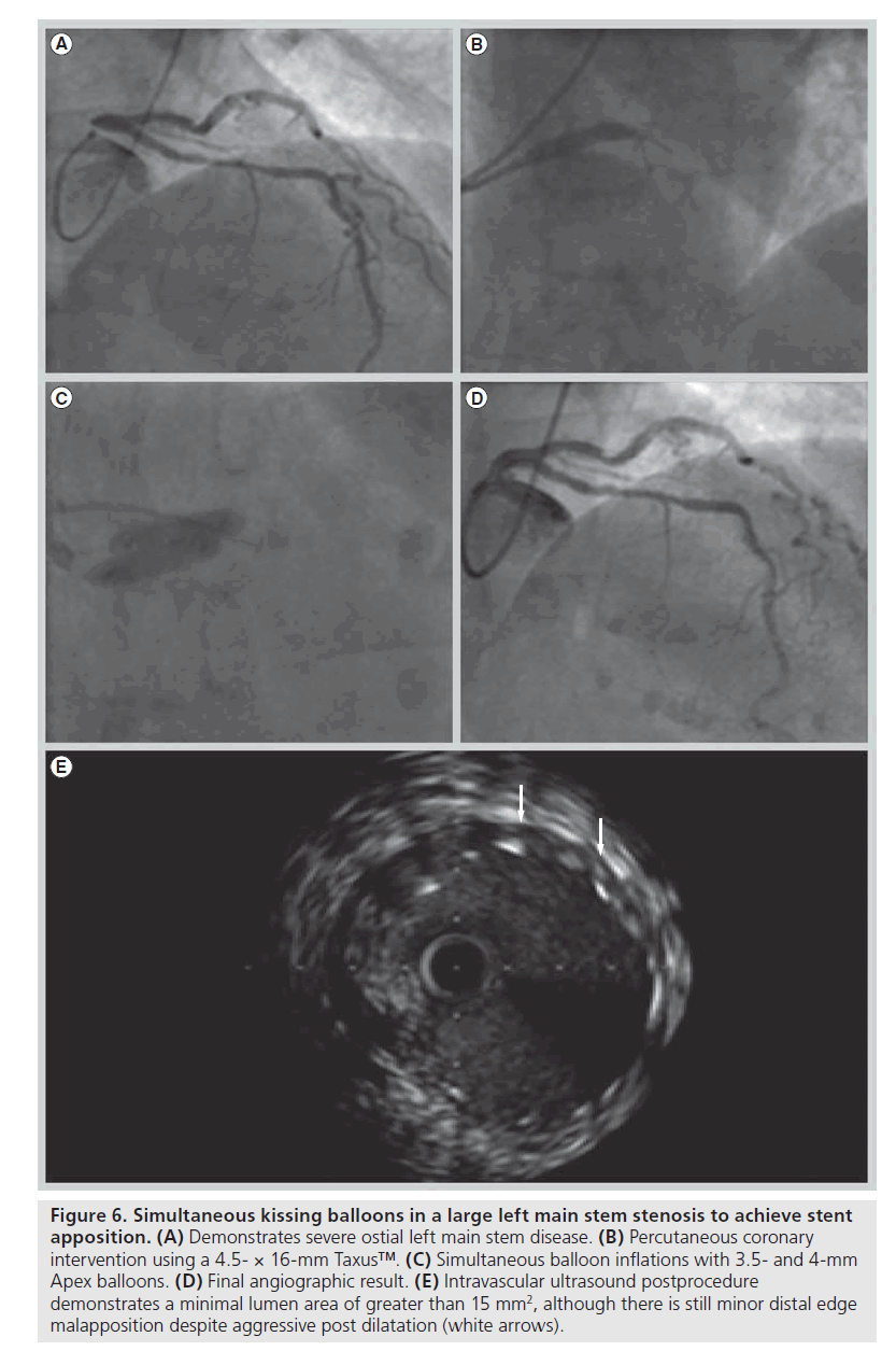 interventional-cardiology-Simultaneous