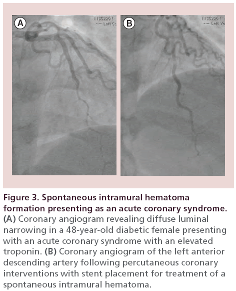 interventional-cardiology-Spontaneous-intramural-hematoma
