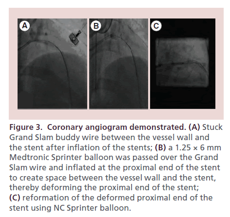 interventional-cardiology-Sprinter-balloon