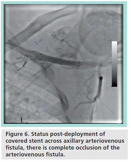 interventional-cardiology-Status-post-deployment