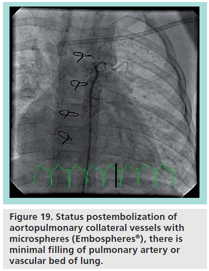 interventional-cardiology-Status-postembolization