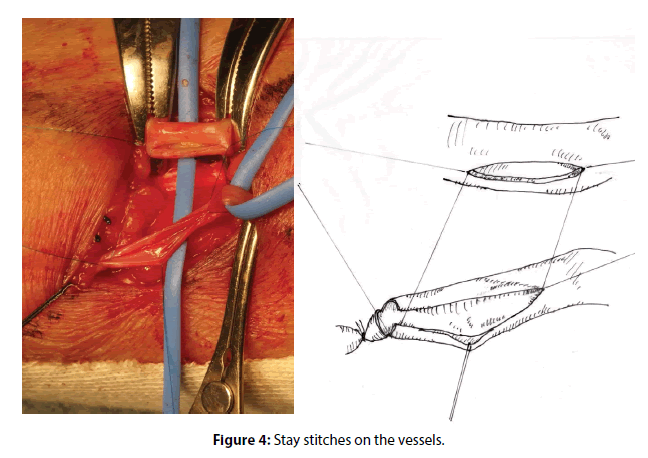 interventional-cardiology-Stay-stitches