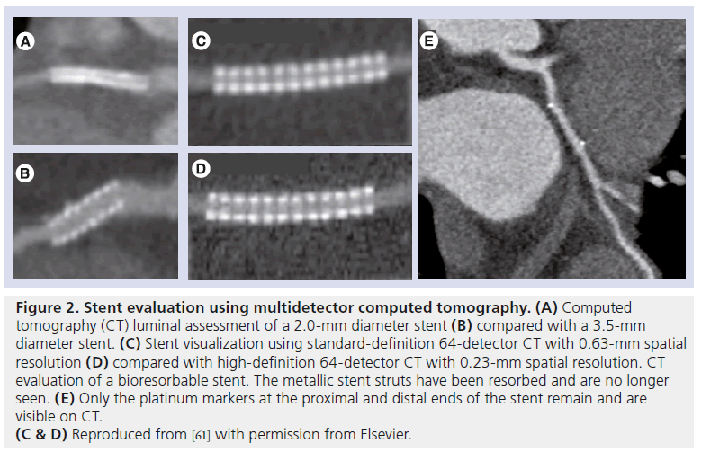 interventional-cardiology-Stent-evaluation