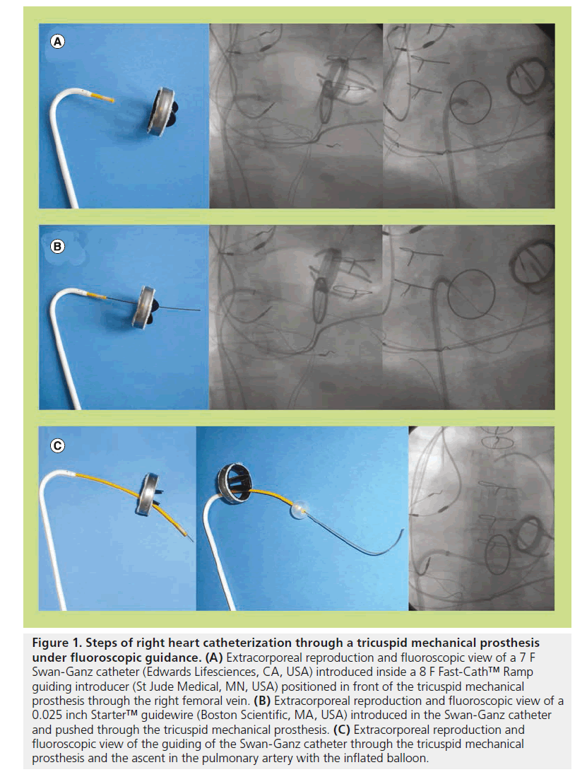 interventional-cardiology-Steps-right