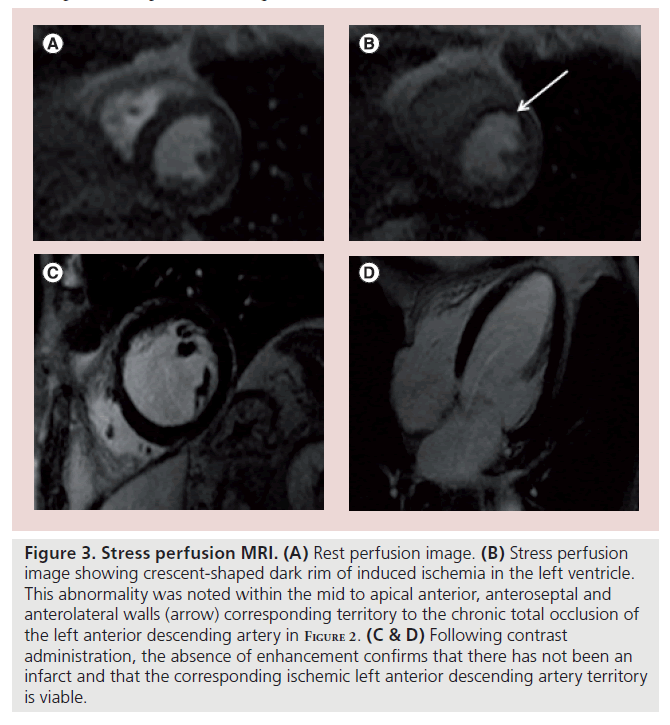 interventional-cardiology-Stress-perfusion