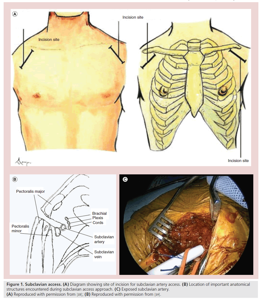 interventional-cardiology-Subclavian-access