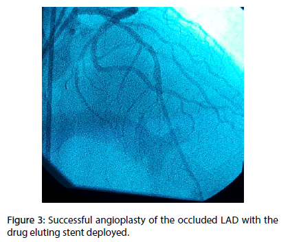 interventional-cardiology-Successful-angioplasty