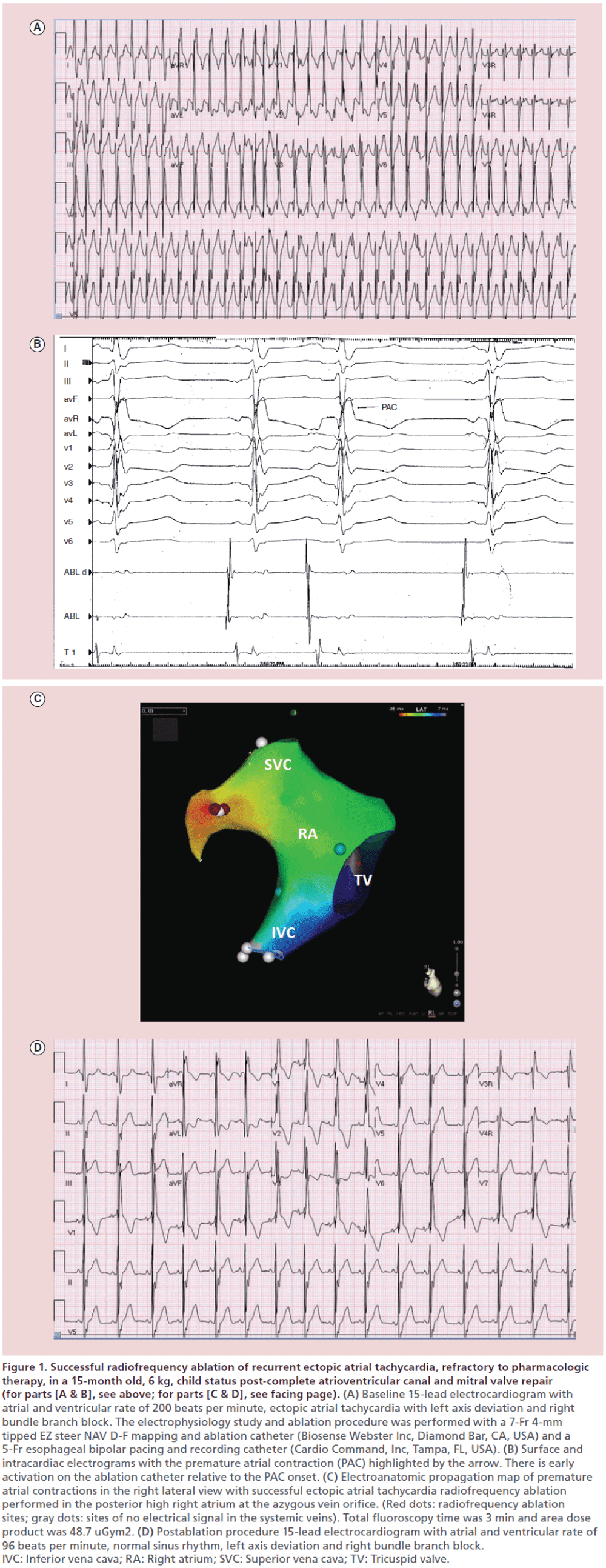 interventional-cardiology-Successful-radiofrequency-ablation