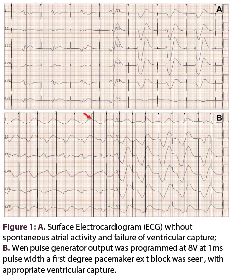 interventional-cardiology-Surface-Electrocardiogram