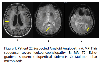 interventional-cardiology-Suspected-Amyloid