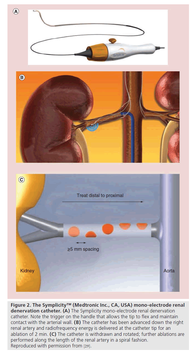 interventional-cardiology-Symplicity-mono