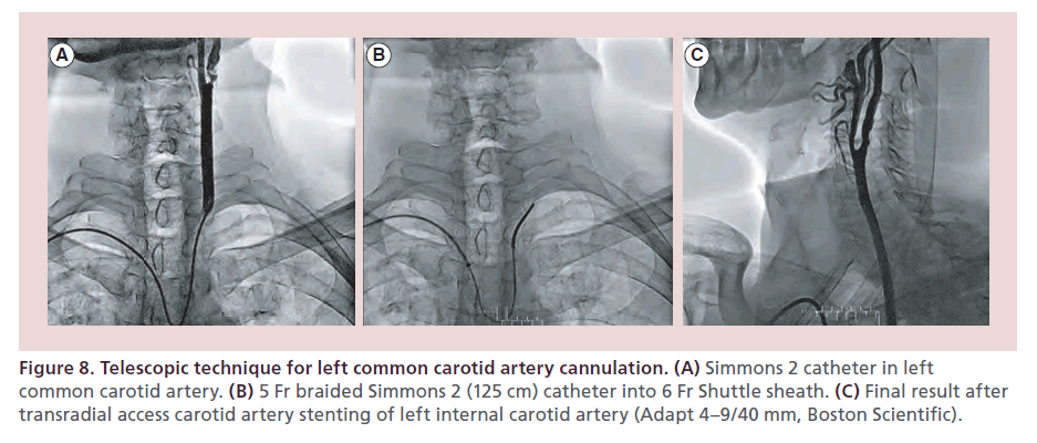 interventional-cardiology-Telescopic-technique