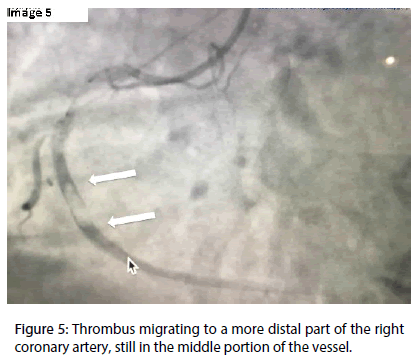 interventional-cardiology-Thrombus-migrating