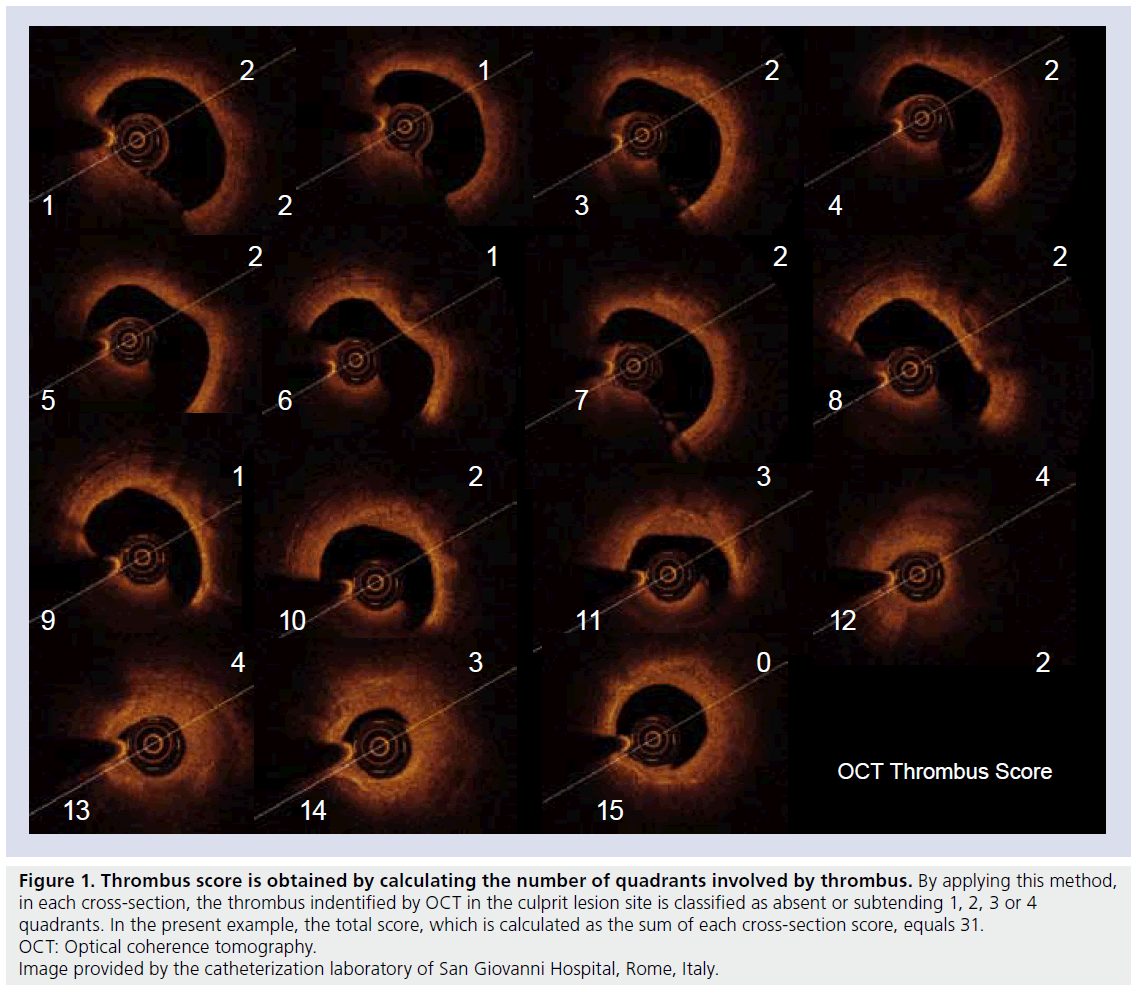 interventional-cardiology-Thrombus-score