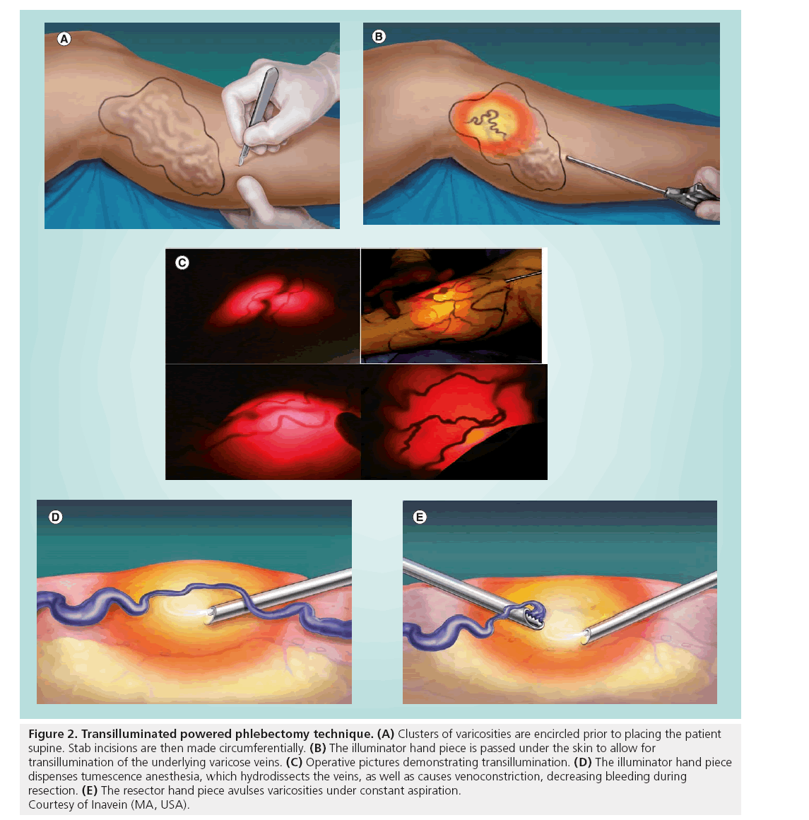 interventional-cardiology-Transilluminated