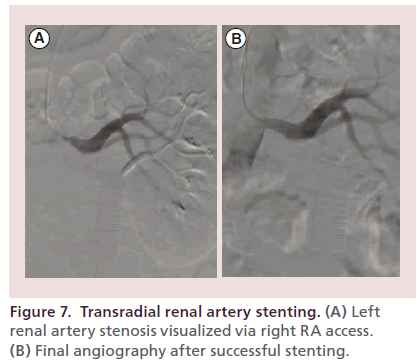 interventional-cardiology-Transradial-renal-artery
